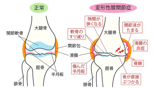 変形性膝関節症について | 調布 | 整形外科 | 調布そわ内科・整形外科